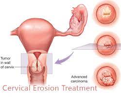 Cervical Erosion Cervical Ectropion