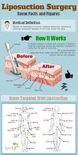 Liposuction Surgery Facts In 2020 Liposuction Mommy Makeover Surgery Laser Liposuction