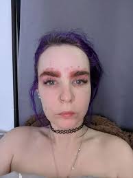 Woman left 'looking like Quasimodo' after deathly reaction to eyebrow tint 