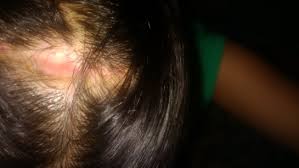 When psoriasis develops on the scalp, hair loss sometimes follows. Does Hair Grow Back On Stitches I Had A Cyst Operation On My Scalp About 4 Months Ago Photo