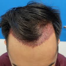 How long do hair implants last? Fue Hair Transplant Timeline Follow His Hair Restoration Journey