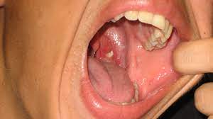 Courtesy of ezinearticles.com by jesse robinson Tonsil Stones Symptoms Treatments And More