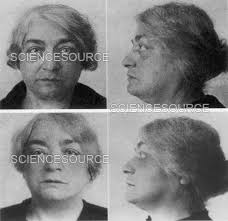 One of First Facelifts by Female Surge