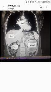 This is probably caused by a tumor that has formed in the body or tail of the pancreas because it can press on the spine. My Doctor Told Me It Was Heartburn For 8 Months Cancerous Tumour Encapsulated The Kidney When Removed It Was The Size Of A Honey Dew Melon And Hadn T Spread Oncologist Couldn T