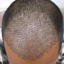 Not only in the fue technique, but it can also happen whichever technique was used. Fue Hair Transplant In Delhi Fue Hair Transplant Treatment In Delhi