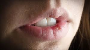 Image result for Oral herpes roof of mouth