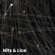Image result for lice vs dandruff