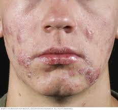 Inflammatory breast cancer (ibc) is rare and is sometimes thought to be some kind of infection. Acne Symptoms And Causes Mayo Clinic