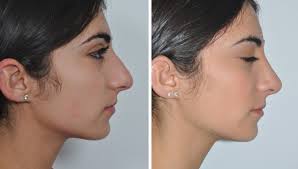 Find out how to finance reconstructive plastic surgery, when insurance doesn't cover it, with help plastic surgery can address defects due to birth disorders, burns, diseases or other trauma. How Much Does Rhinoplasty Cost