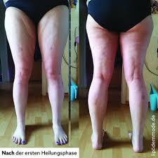 Ein Jahr Post Op Was Hat Die Liposuktion Bewirkt Lipodem Mode
