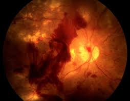 The best way to preserve vision is through annual, detailed eye exams with a doctor who specializes in your unique eye condition. Diabetic Retinopathy Retina Macula Institute