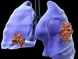 Les stades de cancer de l'estomac se base sur la classification tnm et sont compris entre 0 et 4. Les Differents Types Et Stades De Cancer Du Poumon Doctissimo