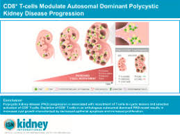 Because diabetes and hypertension have become more common. Cd8 T Cells Modulate Autosomal Dominant Polycystic Kidney Disease Progression Sciencedirect