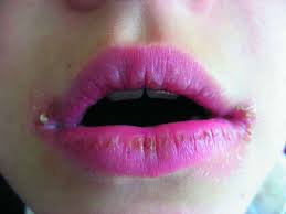 Maybe you would like to learn more about one of these? Jenis Cheilitis Di Bibir Dan Sebab Sebab Perkembangan Mereka Cara Mengubati Penyakit Ini Dengan Cara Tradisional Dan Rakyat