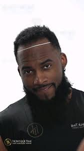 "Now Hair Time" performed a great hair transplant. I had been insecure for  years about my receding hair line. It was male pattern androgenic hair  loss. I decided to fly there via @delta in their ...