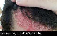 Seboreik Dermatit