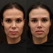 Passageira que negou troca de assento em avião faz harmonização e  surpreende seguidores: 'Muito bom'