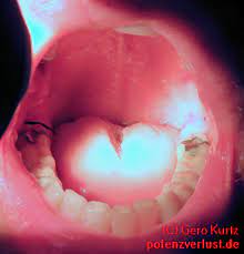 Weisheitszähne können beim wachstum schwerwiegende komplikationen verursachen, deshalb werden sie oft vorsorglich entfernt. Erfahrungsbericht Extraktion Von Vier Weisheitszahnen Gleichzeitig