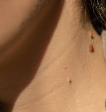 Image result for verrucae filiformes