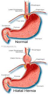 Image result for stomach hernia symptoms
