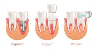 Teeth Procedure Implant Veneer Crown Restoration Dental Crowns Dentistry Design Teeth Implants