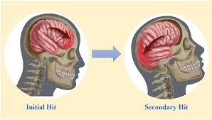 The study is the largest of its kind, and focused on the brains of 202 deceased former football players. Cte The Hidden Risk Of Playing Contact Sports Frontiers For Young Minds