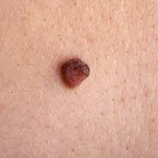 Tumor ini sering muncul di rahim dan disebut fibroid rahim, polip rahim , atau miom. Jenis Tumor Jinak Berdasarkan Letaknya Rsu Dan Holistik Sejahtera Bhakti Salatiga
