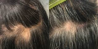 Can white hair turn black again? This New Cytokines Radiofrequency Scalp Treatment Can Increase Hair Growth And Turn Grey Hair Black