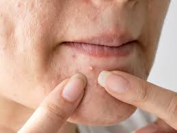 It occurs when dead skin cells mix with the skin's natural oils and clog pores. How To Get Rid Of Whiteheads