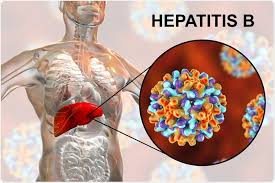 If you test positive for the hepatitis b virus for longer than 6 months, this indicates that you have a chronic hepatitis b infection. Breaking Hepatitis B Uae Covid 19 Case Study Indicates That Covid 19 Could Induce Hepatitis B Virus Reactivation Thailand Medical News