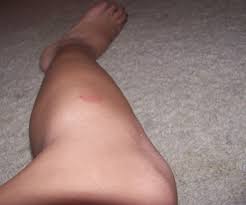 The pain increases with time and other symptoms also appear, such as itching, eyelid puffiness, rapid heart. Spider Bite