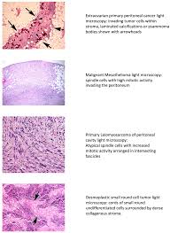 Our free guide includes information on legal compensation, treatment options, and more. Peritoneal Cancer Article