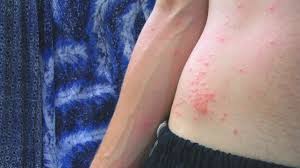 Image result for mosquito bite