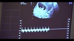 This scan will also show if you are expecting a multiple pregnancy. Early Pregnancy Viability Scan 7 Weeks 11 Weeks Youtube