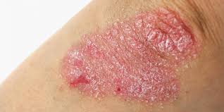 Aos portadores da psoríase, é relevante saber qual a categoria da psoríase que disponibiliza para que o tratamento seja certeiro. Psoriase Aumenta Risco De Aneurisma Da Aorta Abdominal