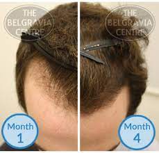 Elon musk hair transplant is proof that balding men can have hair again. Fans Fascinated By Elon Musk S Male Hair Loss Reversal