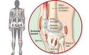 Schleimbeutelentzundung Bursitis Schleimbeutelentzundung Schleim Schleimbeutelentzundung Hufte