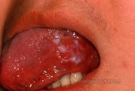 Image result for white cancer on tongue)