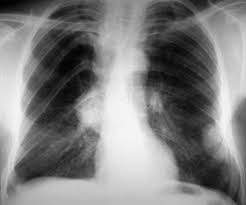 Neurofibromatosis Type 1 Ribbon Ribs Radiology Case Radiopaedia Org Radiology Neurofibromatosis Type 1 Radiology Imaging