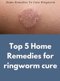 Top 5 Home Remedies For Ringworm Cure Homeremediesforringworm Top 5 Home Remedies For Ringworm Cure Home Remedies For Ringworm Ringworm Remedies Ringworm Cure