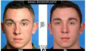 But if your deviated septum blocks one or both nostrils so that it's hard or impossible to breathe through your nose, you may want to consider surgery. Revision Rhinoplasty San Antonio Texas Nose Job Repair Dr Jose Barrera