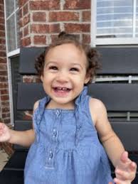 Image result for Homocystinuria