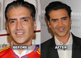 He also has five children; Did Alejandro Fernandez Have Cosmetic Surgery Specialist Says That El Potrillo Got A Facial Rhytidectomy See Photo Here