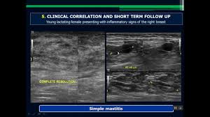 Pin On Breast Imaging