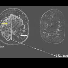 Inflammatory breast cancer differs from other types of breast cancer. Inflammatory Breast Cancer Eurorad
