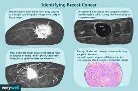 Mammographic features predictive of malignancy include masses with spiculated margins (ppv 81%) and irregular shape (ppv 73%), while masses with . Breast Masses Cancerous Tumor Or Benign Lump