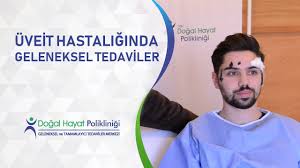 Uveit Hastaliginda Geleneksel Tedaviler Youtube