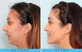 An overbite is defined by a degree of overlap of the upper and lower teeth. Underbite Without Surgery Orthognathic Surgery Jaw Surgery Surgery