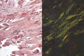 An acid dye used in testing for hydrochloric acid in gastric contents. Congo Red Highman Kit Biognost