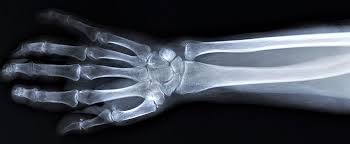 Image result for Fracture